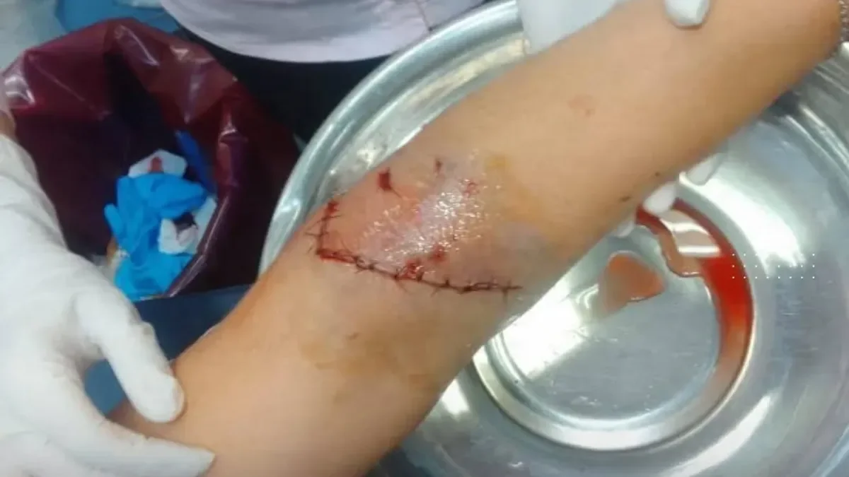 Loncopué: mujer herida tras ataque de perro requiere atención médica urgente